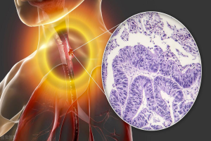 食道癌有哪些表现？ 缩略图